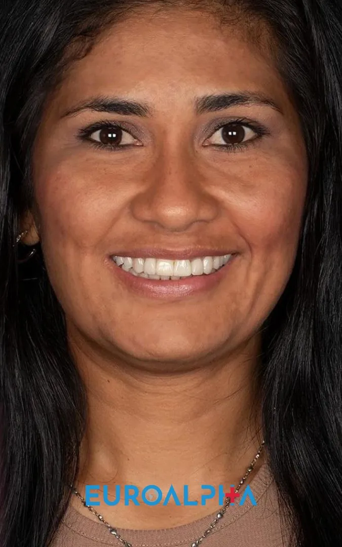 Hollywood smile — After