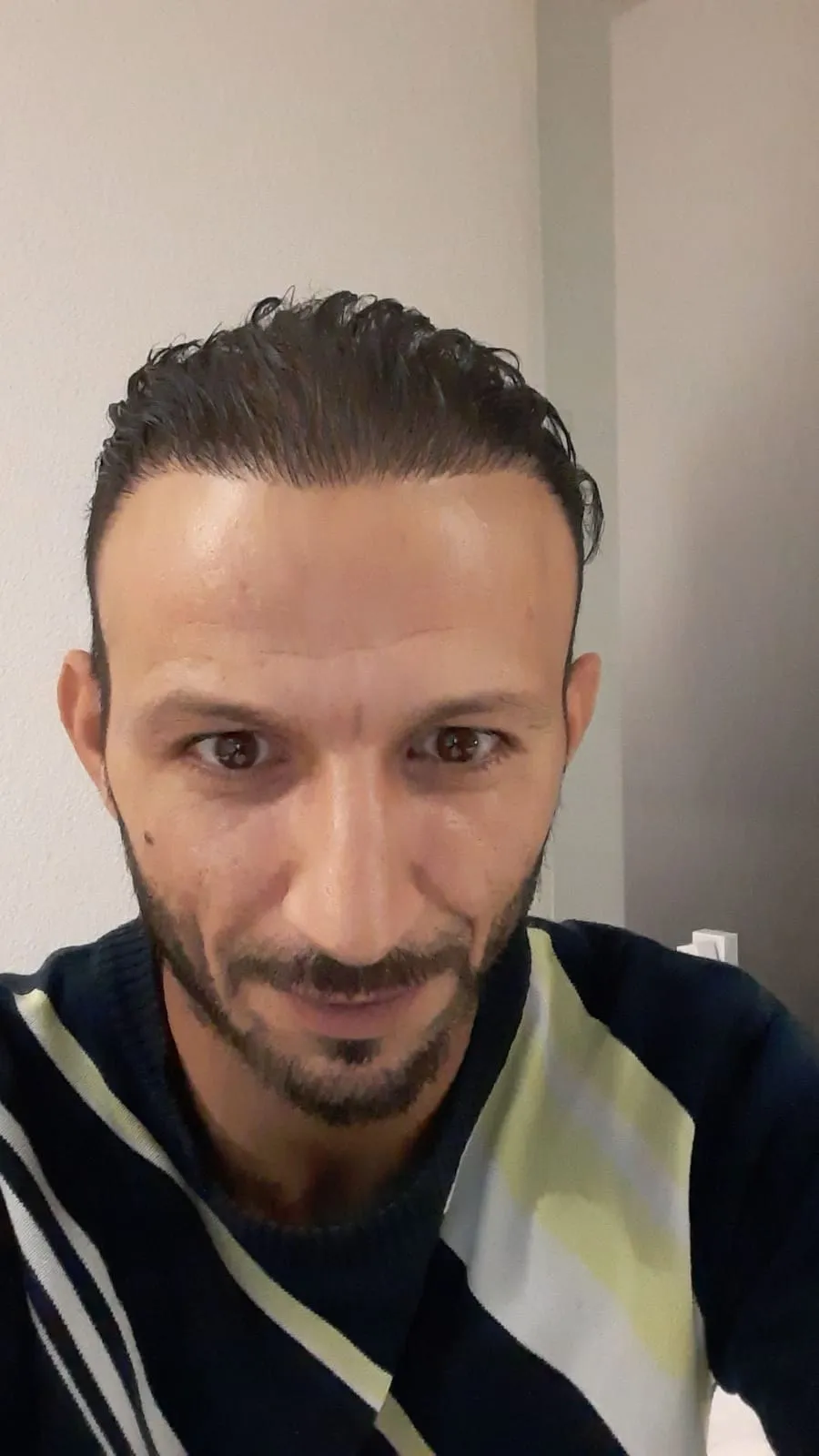 FUE — After