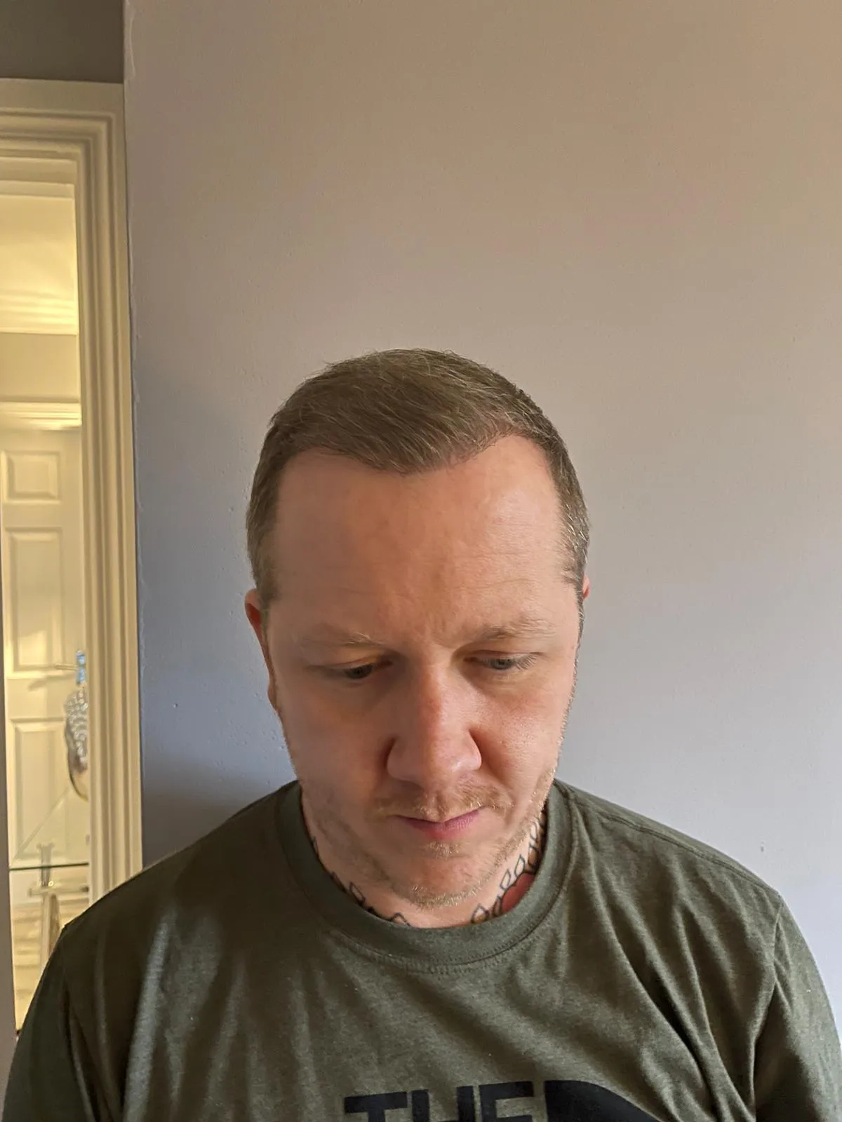 FUE — After