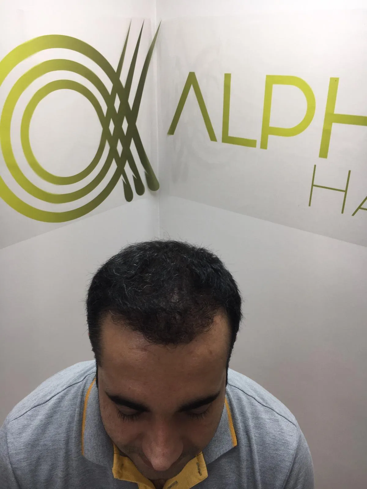 FUE — After