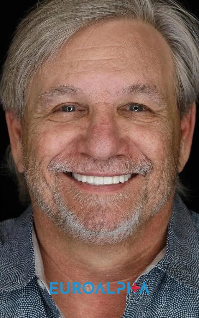 Hollywood smile — After