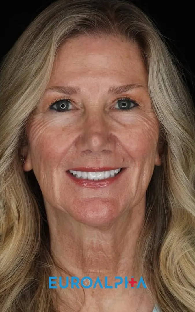 Hollywood smile — After