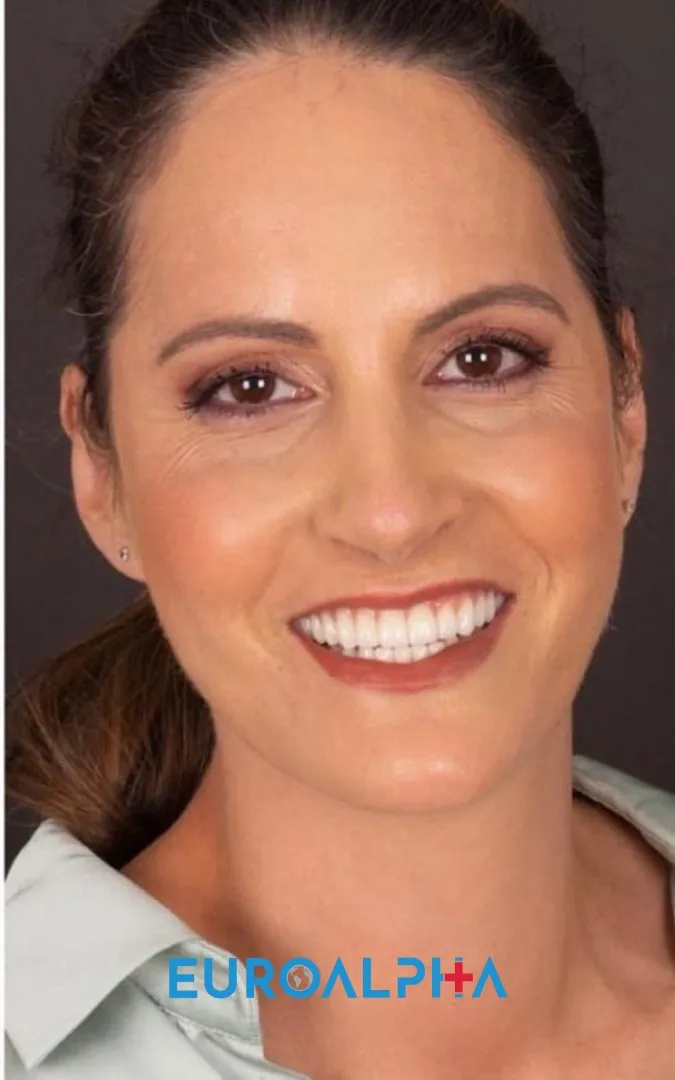 Hollywood smile — After