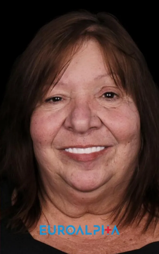 Hollywood smile — After
