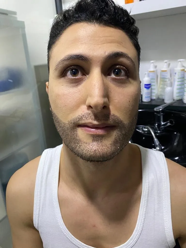 Beard & moustache — After