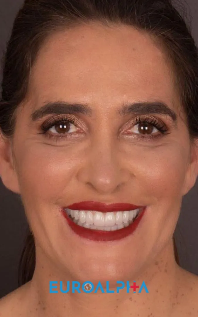 Dental implant — After