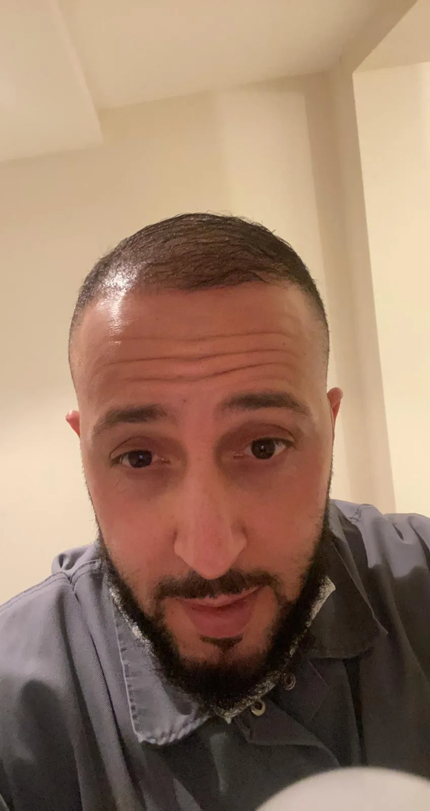 FUE — After
