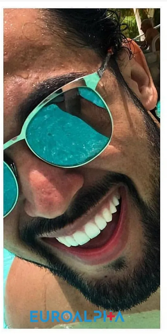 Hollywood smile — After