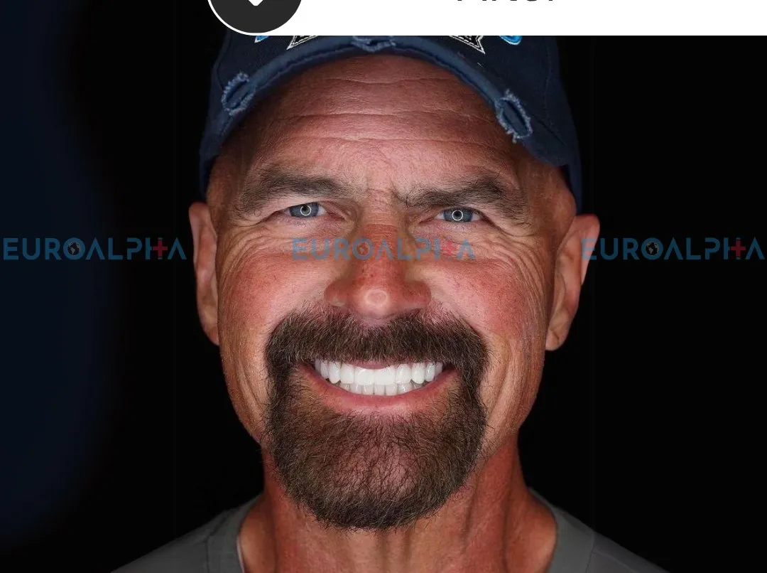 Hollywood smile — After