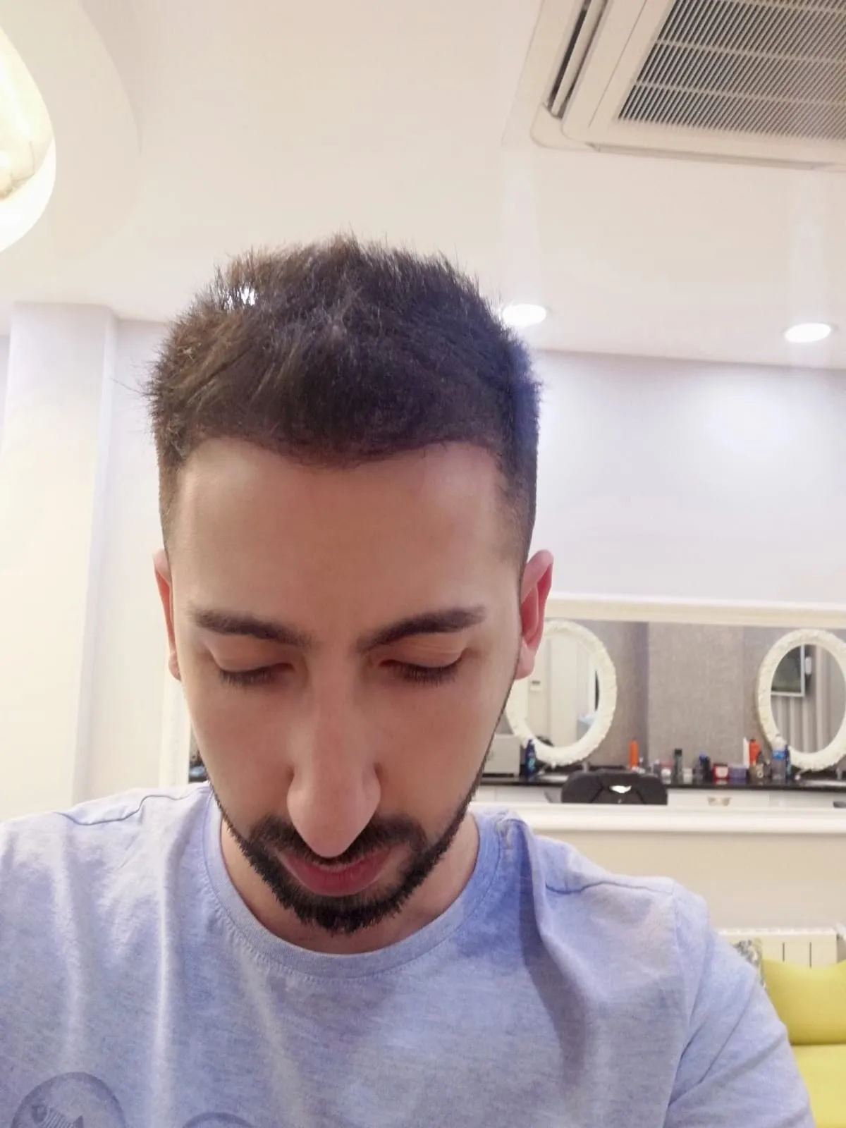 FUE — After