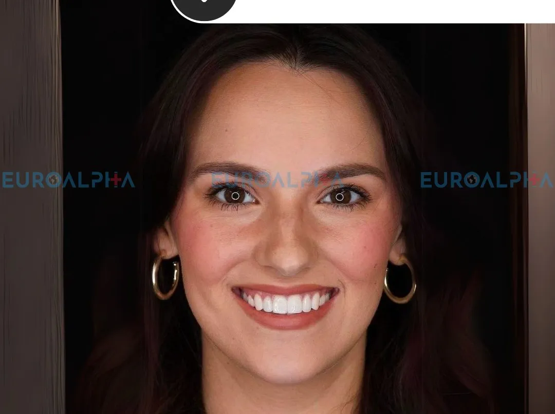 Hollywood smile — After