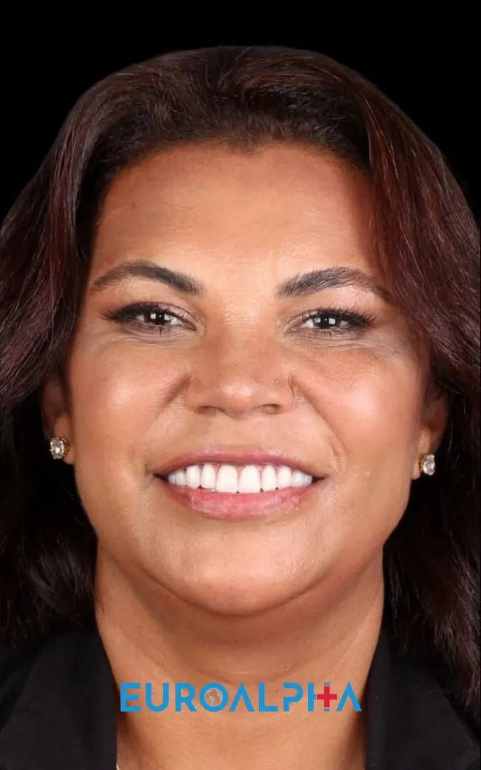 Dental implant — After