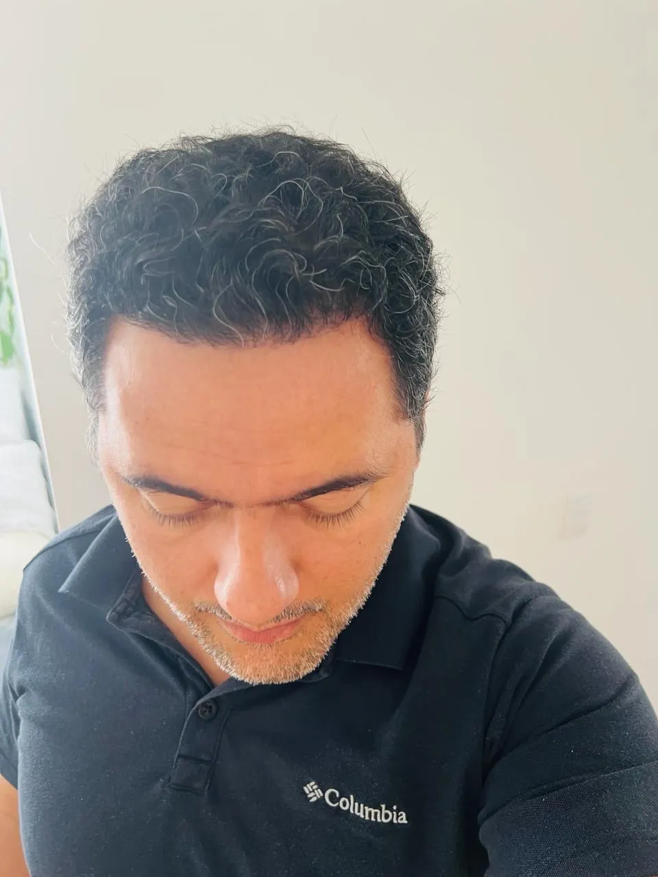 FUE — After