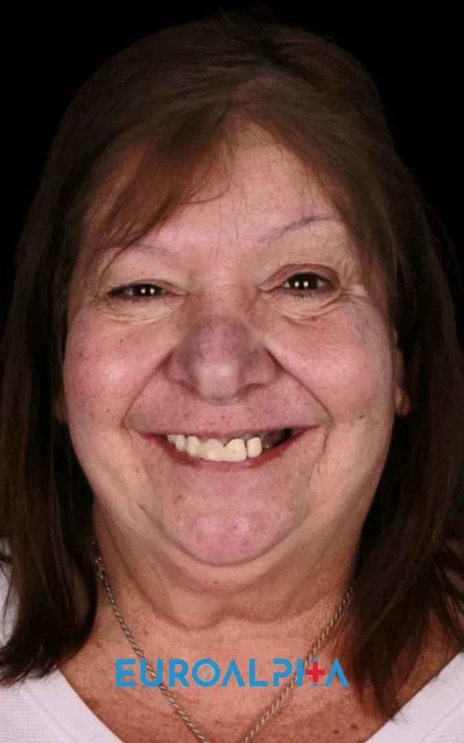 Hollywood smile — Before