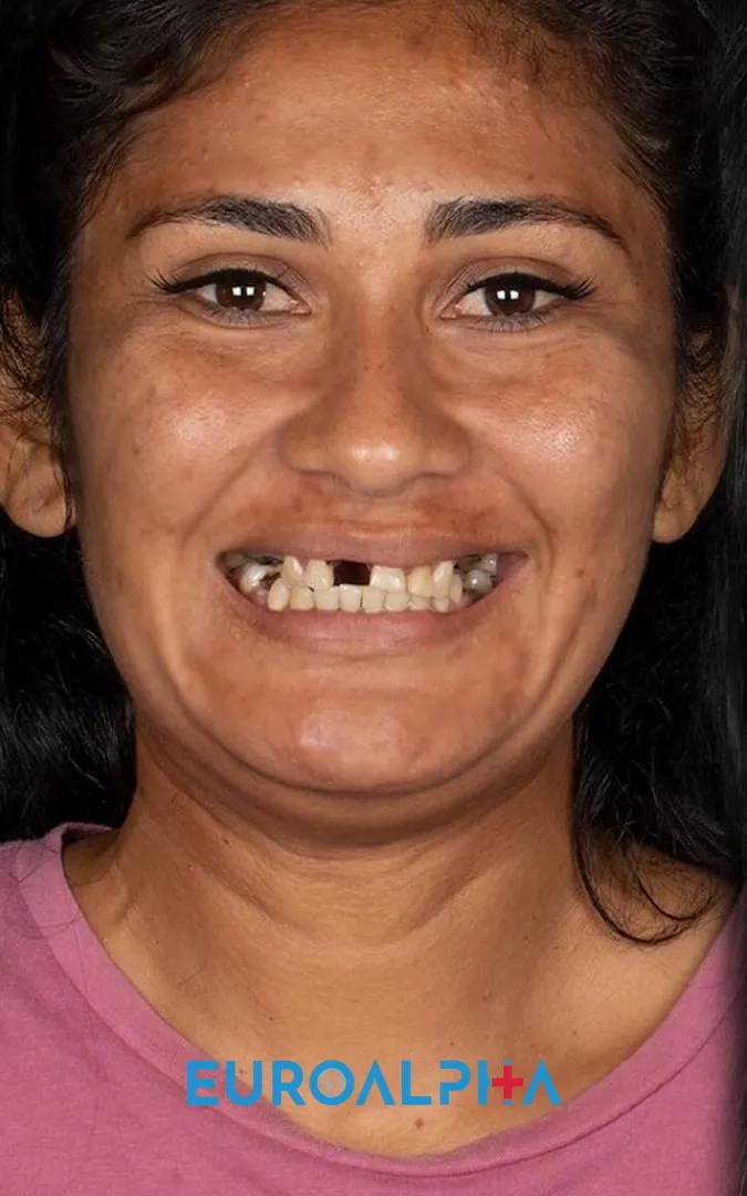 Hollywood smile — Before