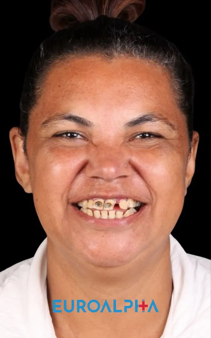 Dental implant — Before