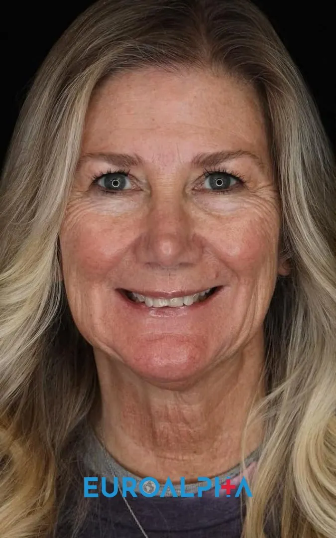 Hollywood smile — Before