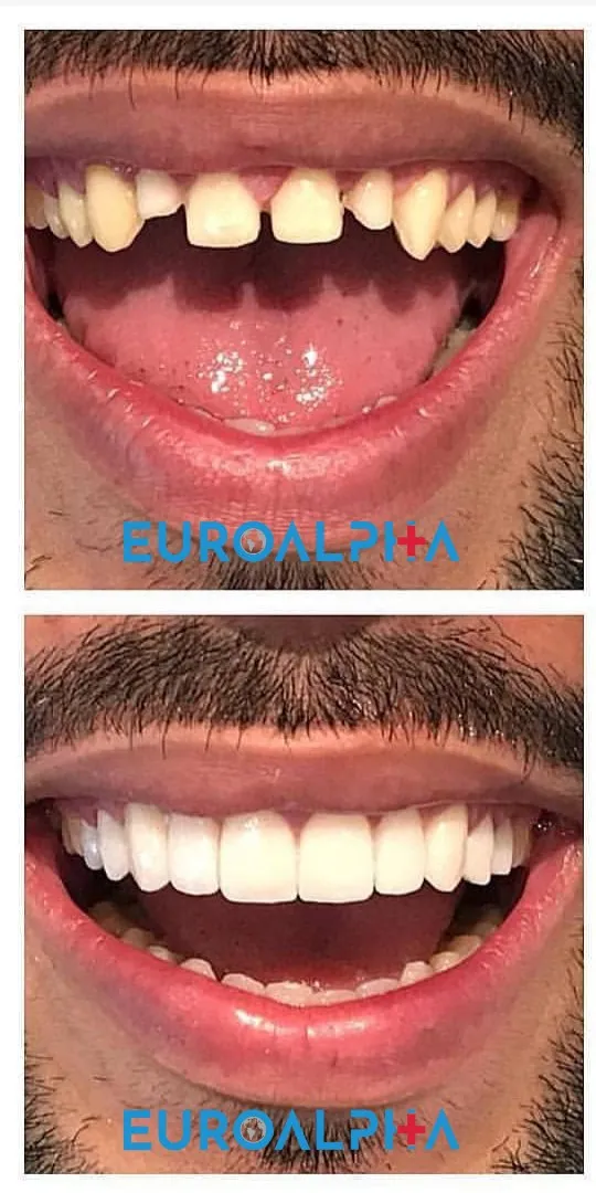 Hollywood smile — Before