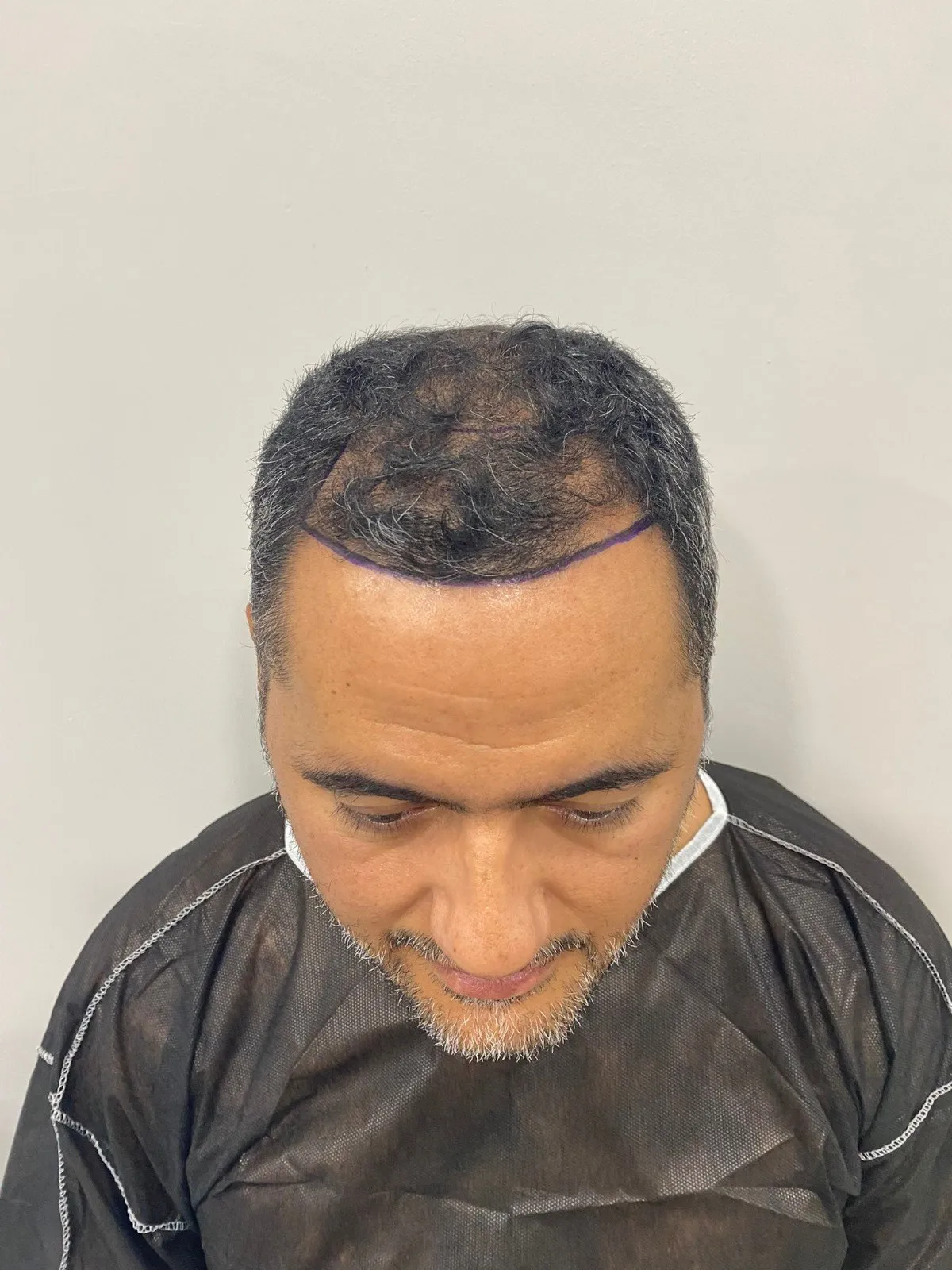 FUE — Before