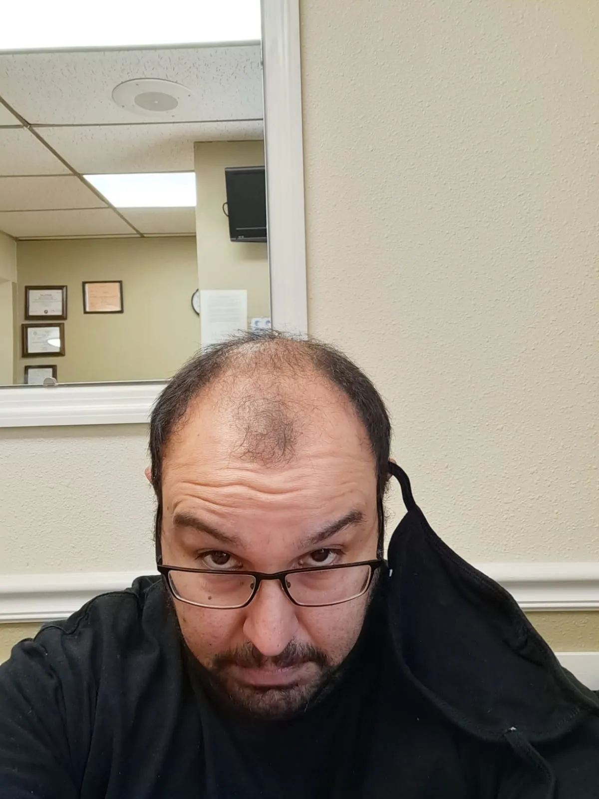 FUE — Before