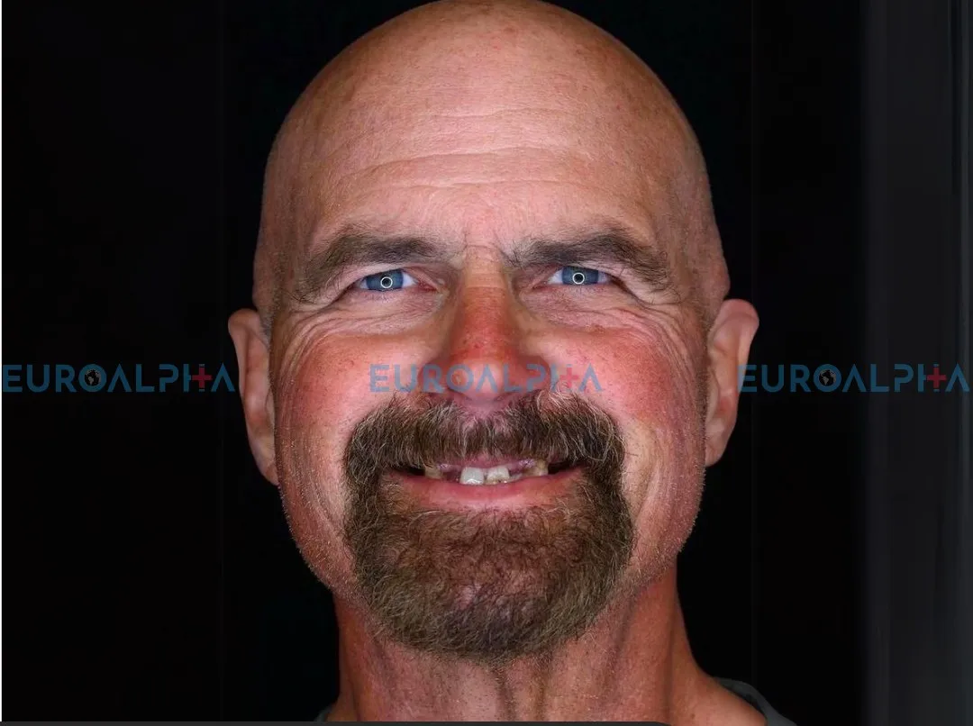 Hollywood smile — Before