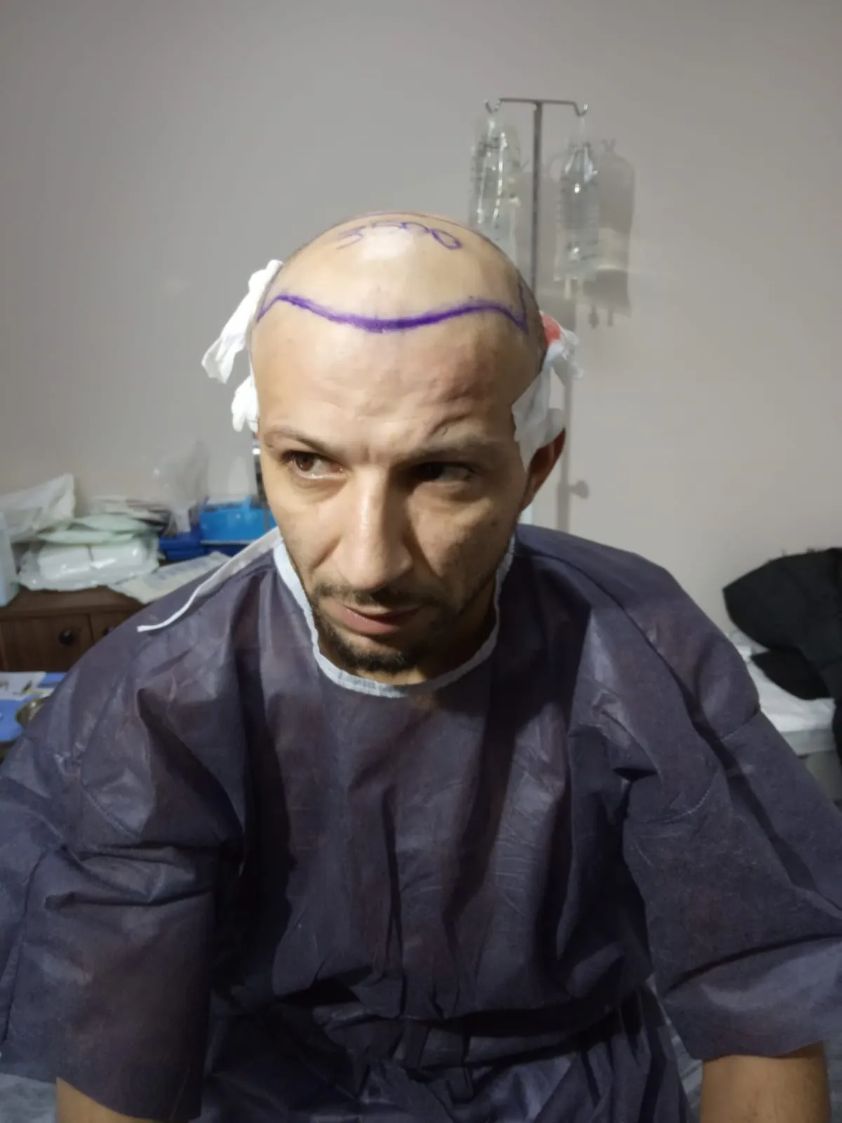 FUE — Before