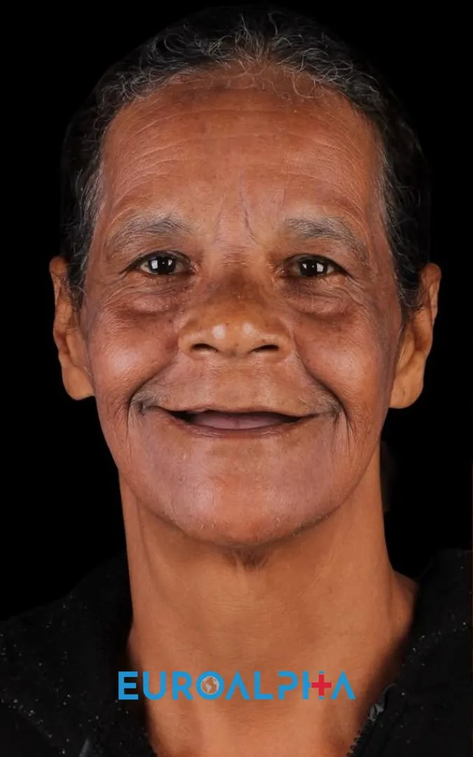 Dental implant — Before