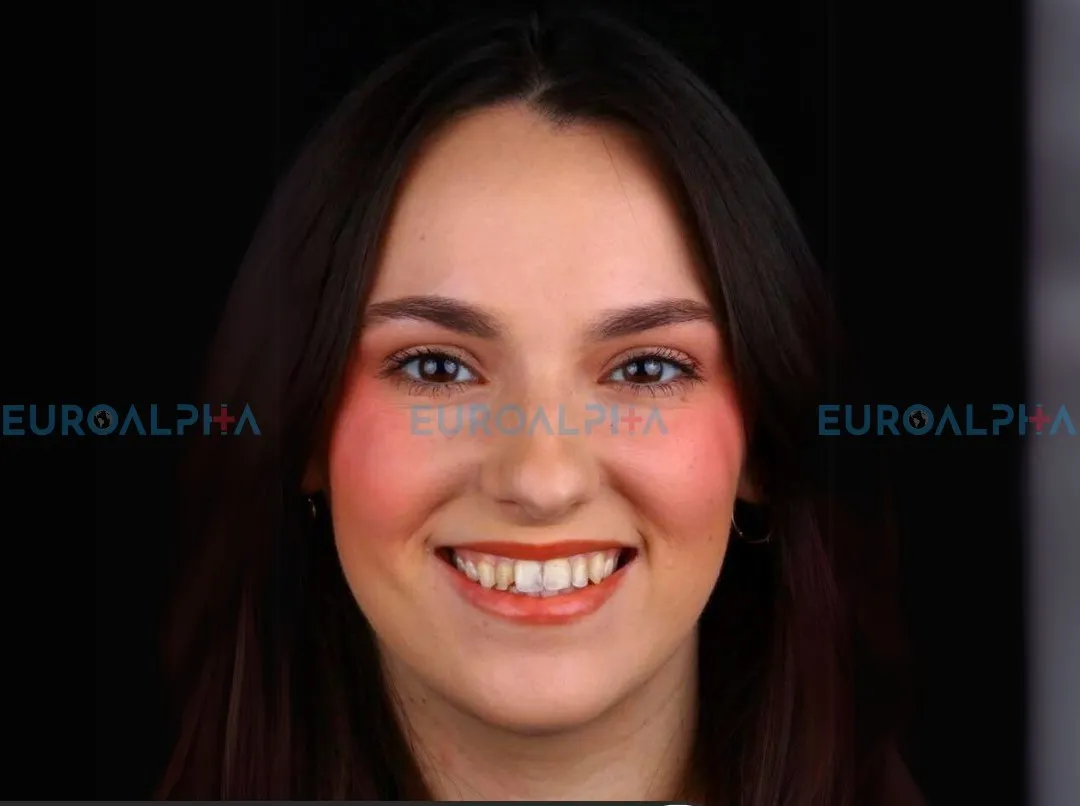Hollywood smile — Before