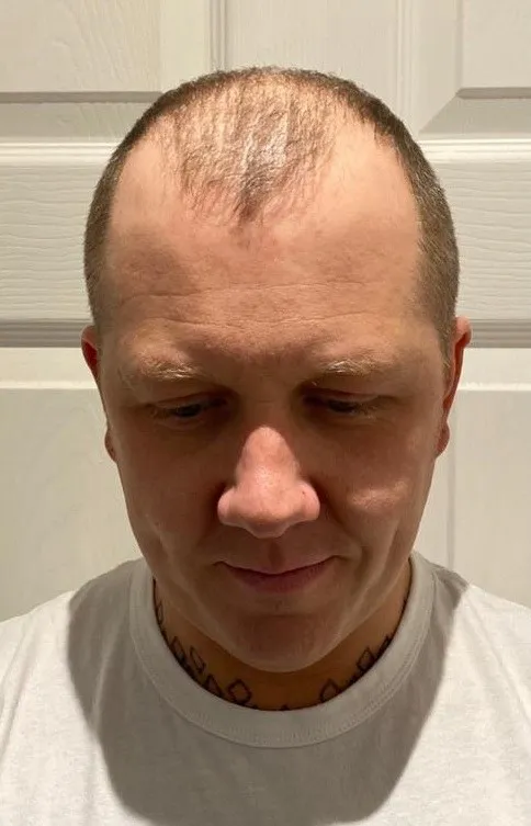 FUE — Before