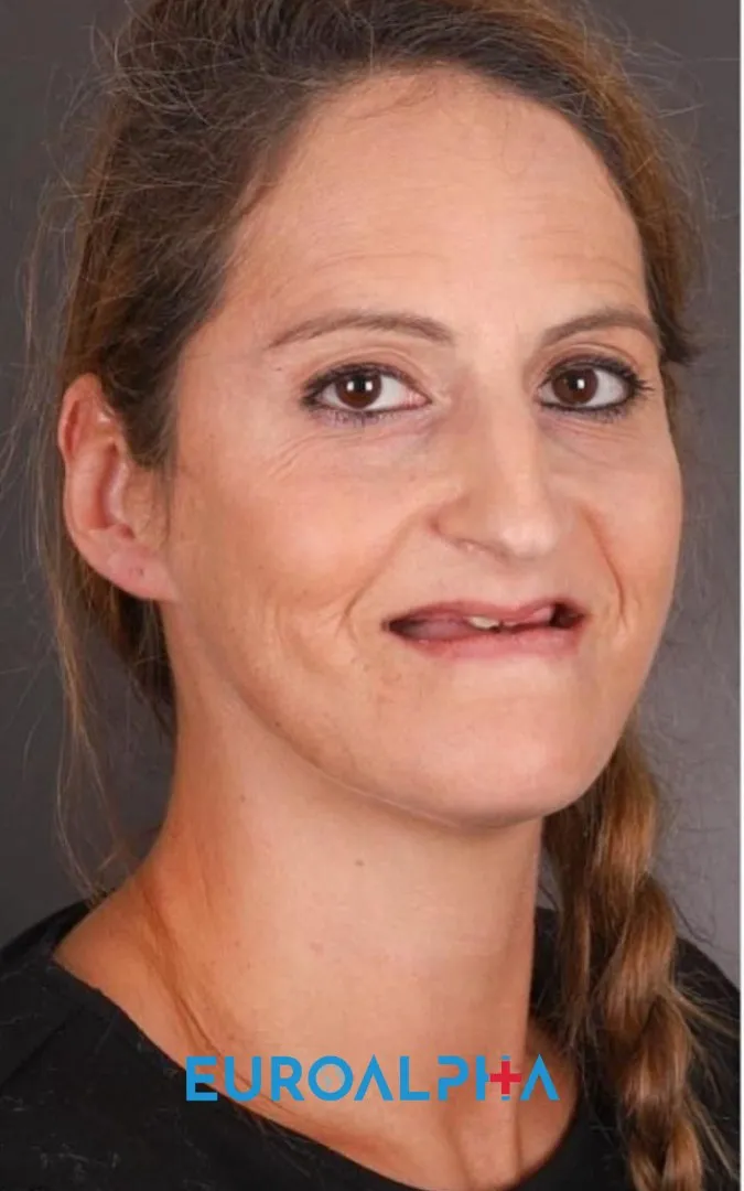 Hollywood smile — Before