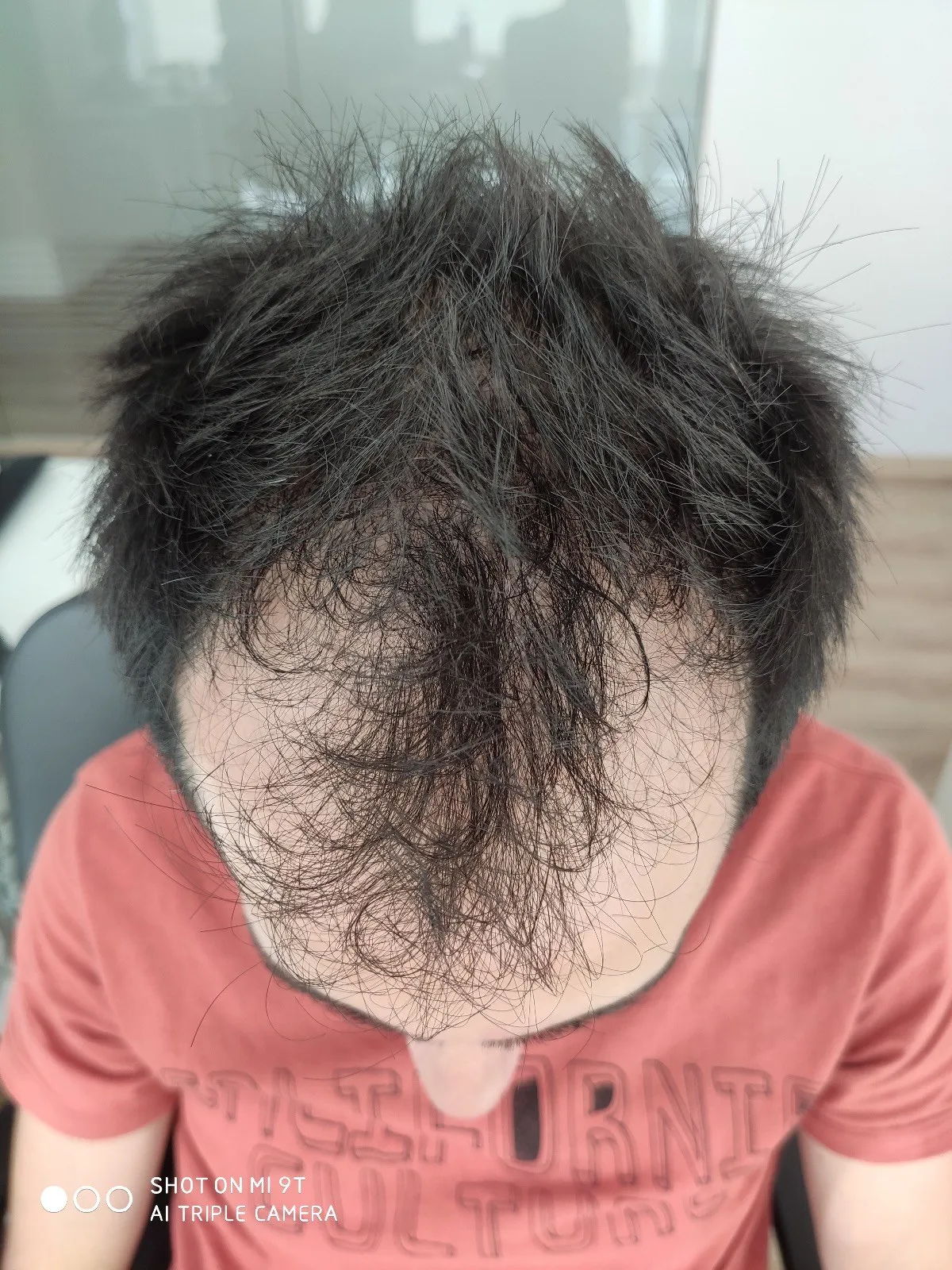 FUE — Before