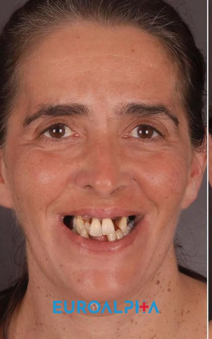 Dental implant — Before