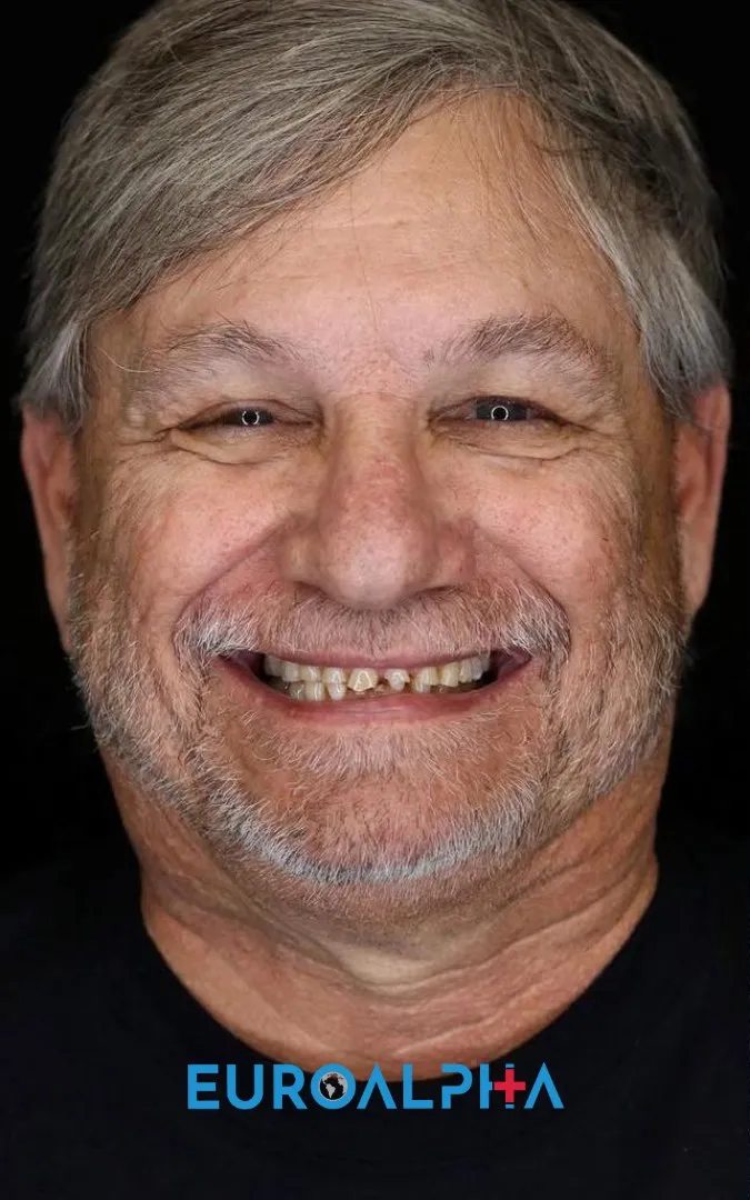Hollywood smile — Before